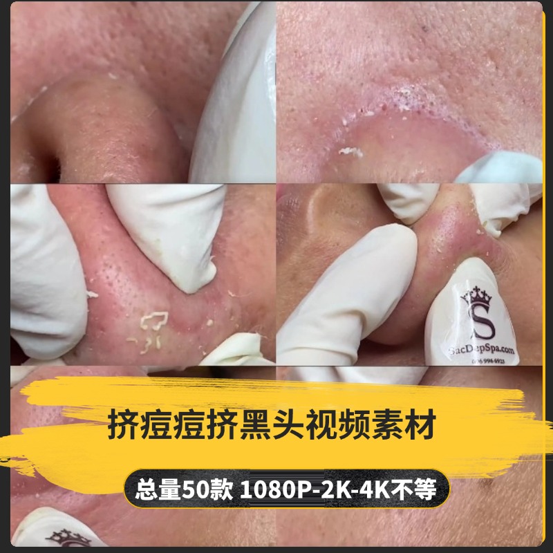 【50款】挤痘痘挤黑头解压视频素材-捷亚素材网