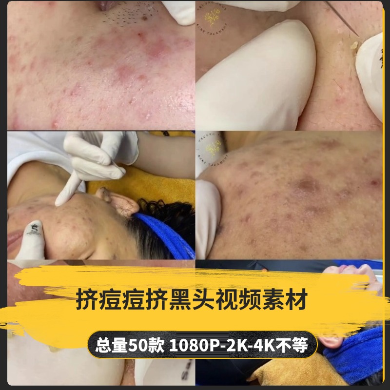 【50款】挤痘痘挤黑头解压视频素材-捷亚素材网