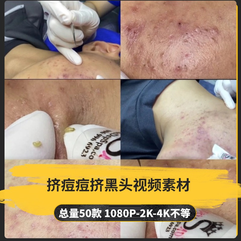 【50款】挤痘痘挤黑头解压视频素材-捷亚素材网