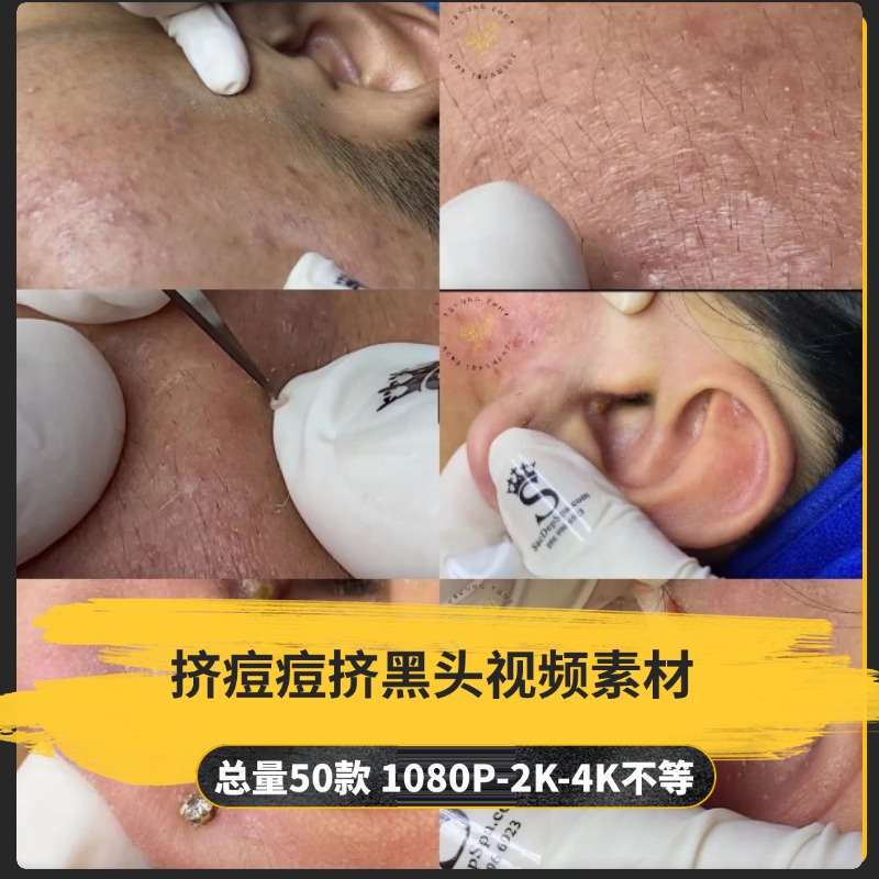 【50款】挤痘痘挤黑头解压视频素材-捷亚素材网