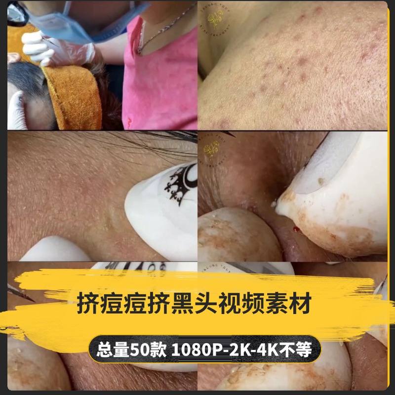 【50款】挤痘痘挤黑头解压视频素材-捷亚素材网