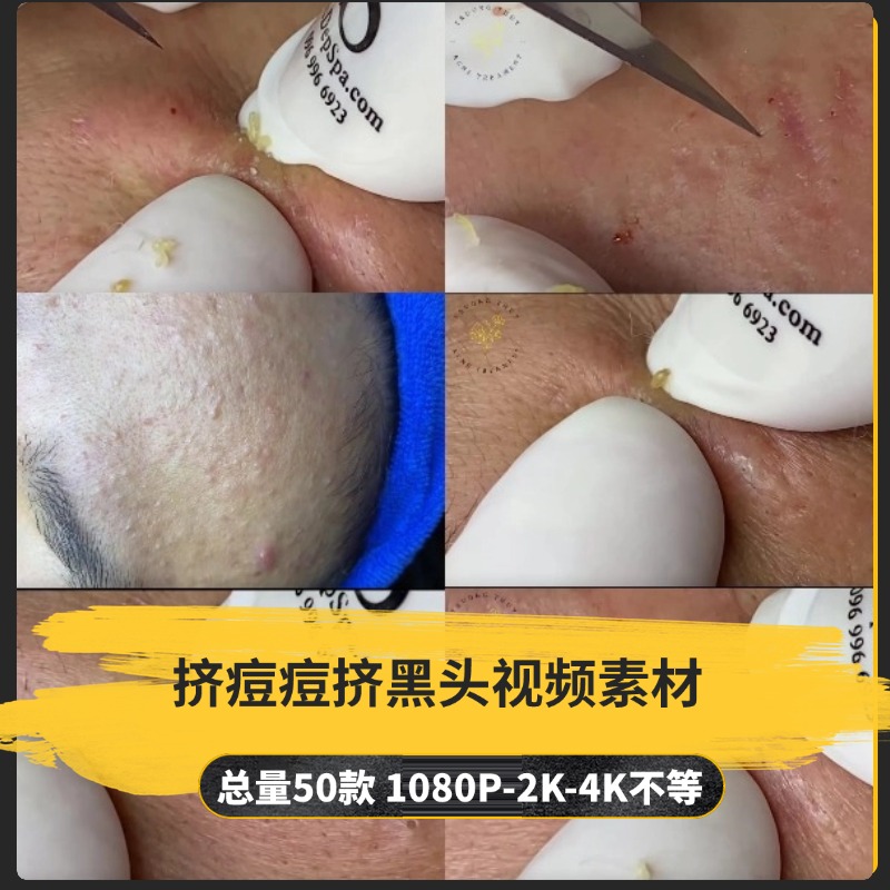 【50款】挤痘痘挤黑头解压视频素材-捷亚素材网